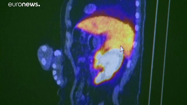 Великобритания: из-за коронавируса смертность от рака может вырасти на 20 %