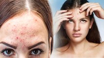 Forehead पर Pimples आने से रोकने के लिए ये हैं आसान घरेलु उपाय | Pimples On Forehead | Boldsky