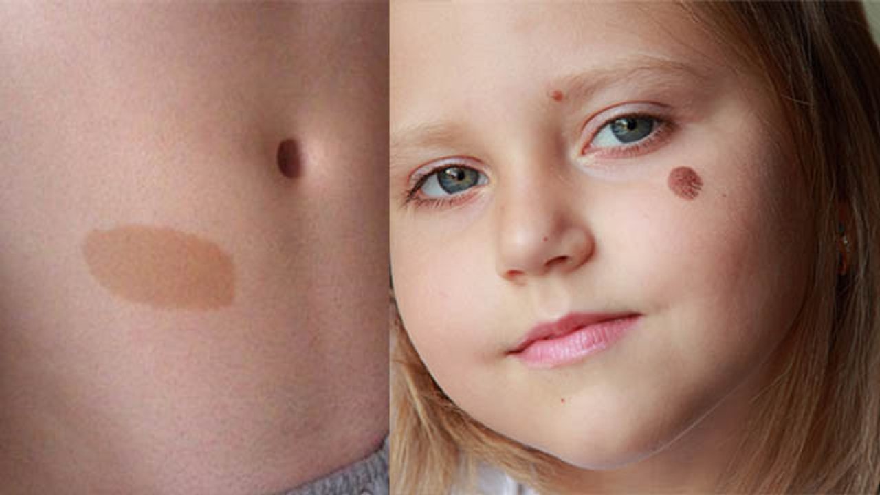 जानिए क्या होता है बर्थमार्क जो आपके जीवन पर डालता है गहरा असर | Birthmark Meaning | Boldsky
