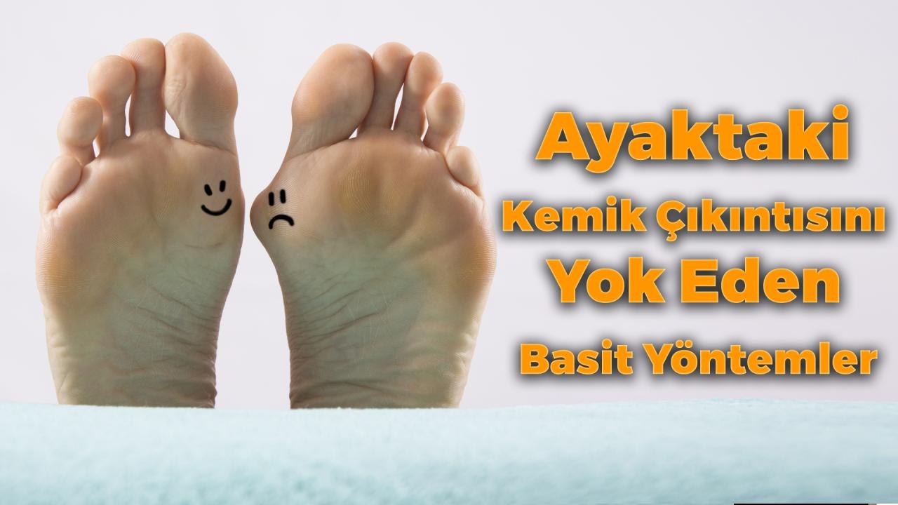 Ayaktaki Kemik Çıkıntısını Yok Eden Basit Yöntemler