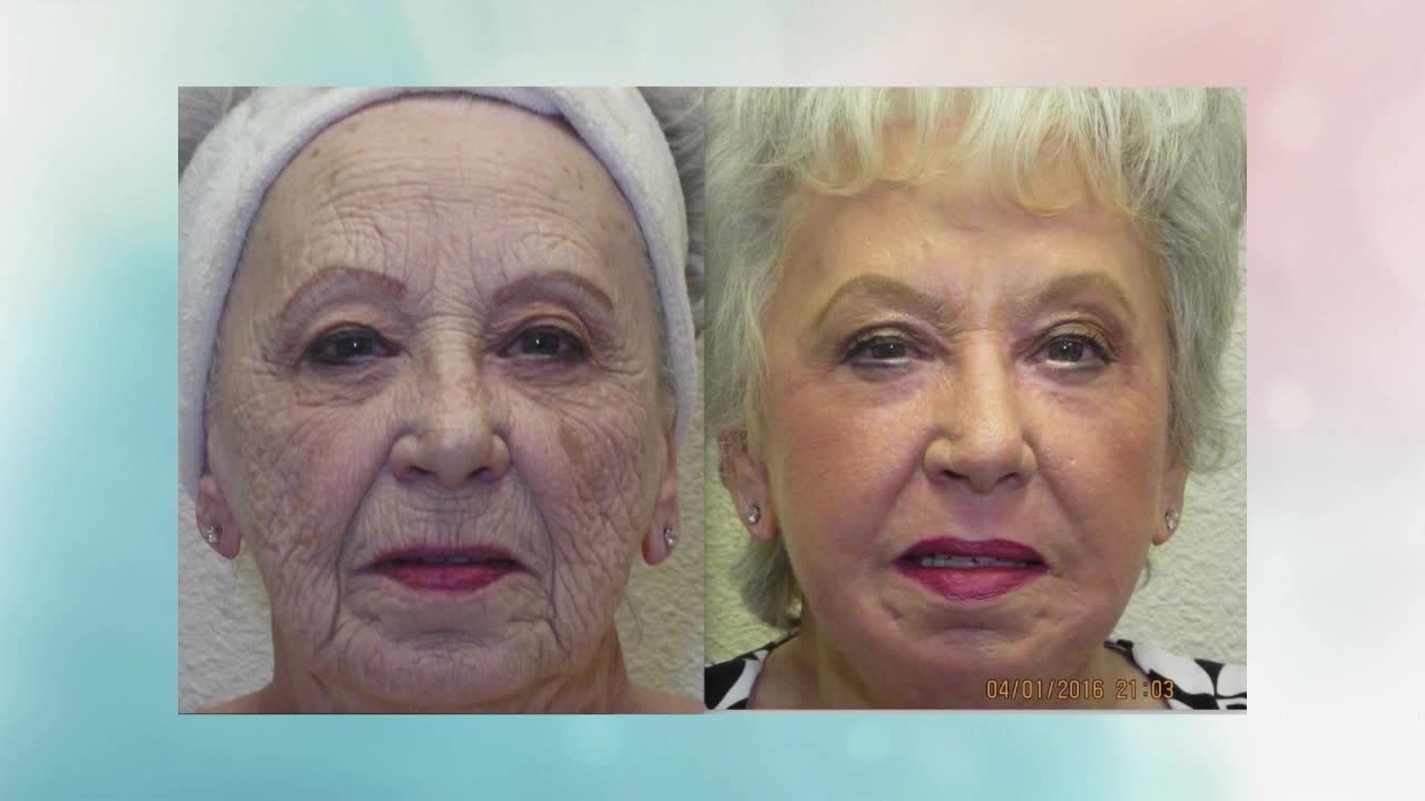WOW! Look years younger with ONE treatment from...