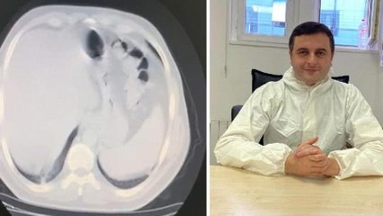 Coronayı yenen doktor anlattı: Bilinç kaybı yaşadım, akciğerimin yüzde 70’ini virüs kaplamıştı