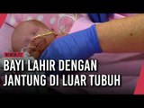 Bayi Lahir dengan Jantung di Luar Tubuh