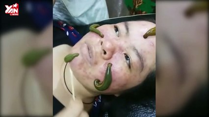 Kinh hãi cách chữa mụn bằng cách thả đỉa lên mặt để hút mụn