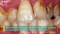 Những thói quen hằng ngày là yếu tố chính gây phá hủy răng