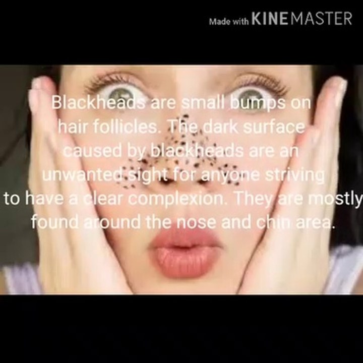 GET RID OF BLACKHEADS (3 Proven ways)