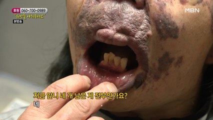 앞니 네 개가 전부라는 주인공의 치아 상태