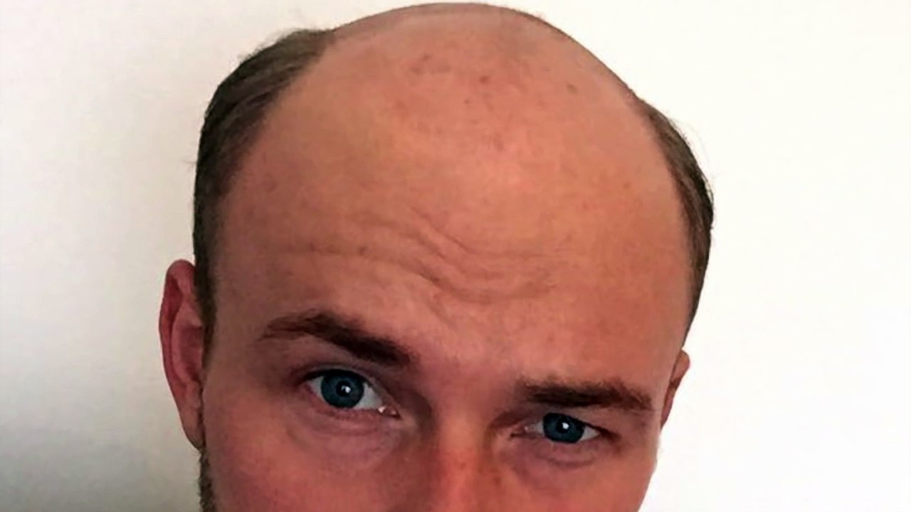 Đập tan nỗi lo sợ hói đầu với sản phẩm tóc giả “đẹp hơn cả tóc thật”