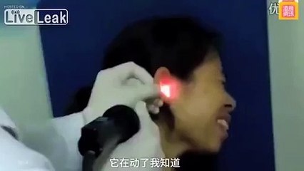 Kinh hãi bác sĩ gắp con gián còn sống trong tai người phụ nữ