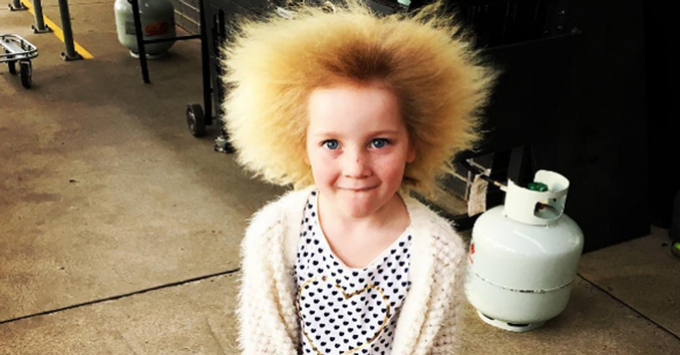 Cette fillette atteinte du syndrome des cheveux incoiffables ressemble à une poupée troll