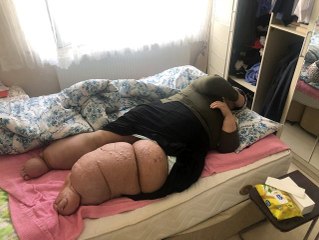 Yakalandığı fil hastalığı onu eve mahkum etti