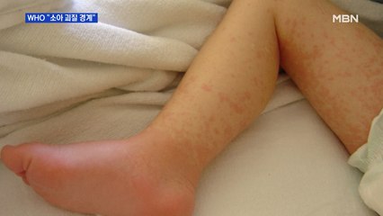 코로나19 걸린 뒤 '소아 괴질' 잇따라…WHO "의료진 경계 필요"
