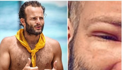 Alban Pellegrin de Koh-Lanta défiguré suite à une greffe de cheveux