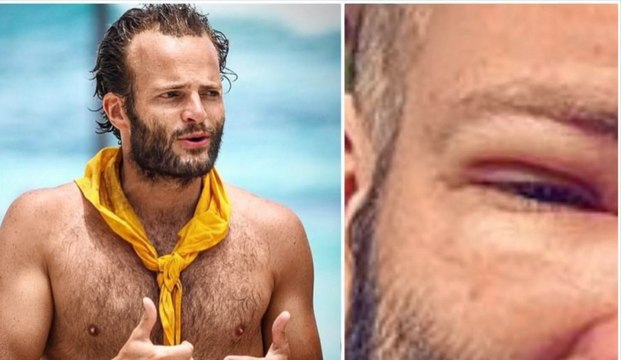 Alban Pellegrin de Koh-Lanta défiguré suite à une greffe de cheveux