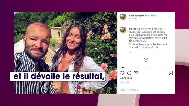 Alban (Koh-Lanta) se montre défiguré après une greffe de cheveux