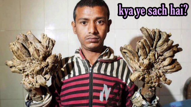 Is tree man a reality?? janiye Sach ( In hindi ) || Bizarre Medical condition part 2 || World Most weird and rare illness on our planet || Pharma Guru Medical information for very rare syndromes