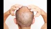 Baldness cure possible as study shows stem cell solution can trigger hair regrowth