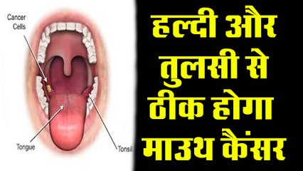 बीएचयू  के डॉक्टरों ने किया माउथ कैंसर ठीक करने का दावा