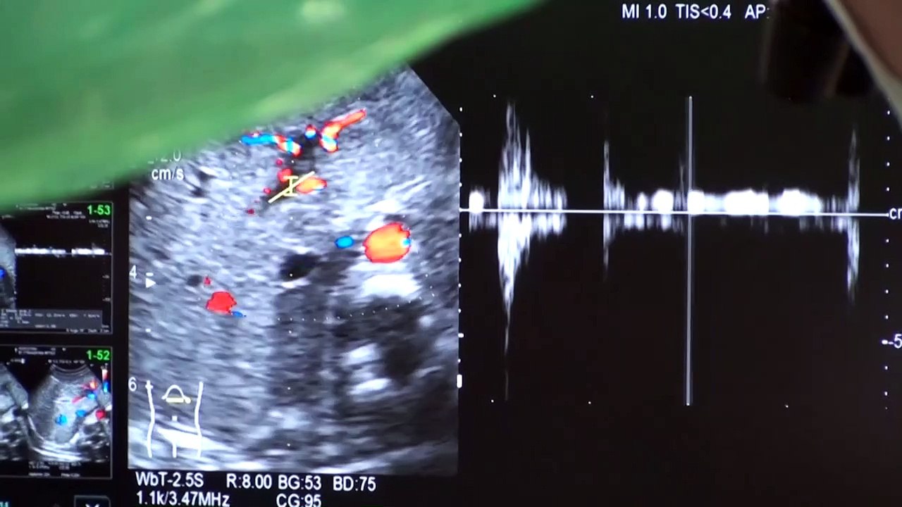 Tratamiento pionero en Japón con células madre a un bebé con problemas de hígado