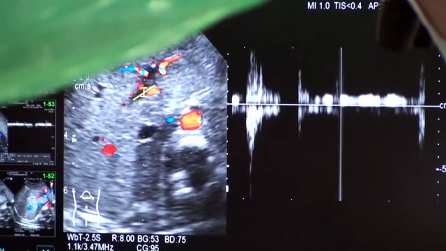 Tratamiento pionero en Japón con células madre a un bebé con problemas de hígado