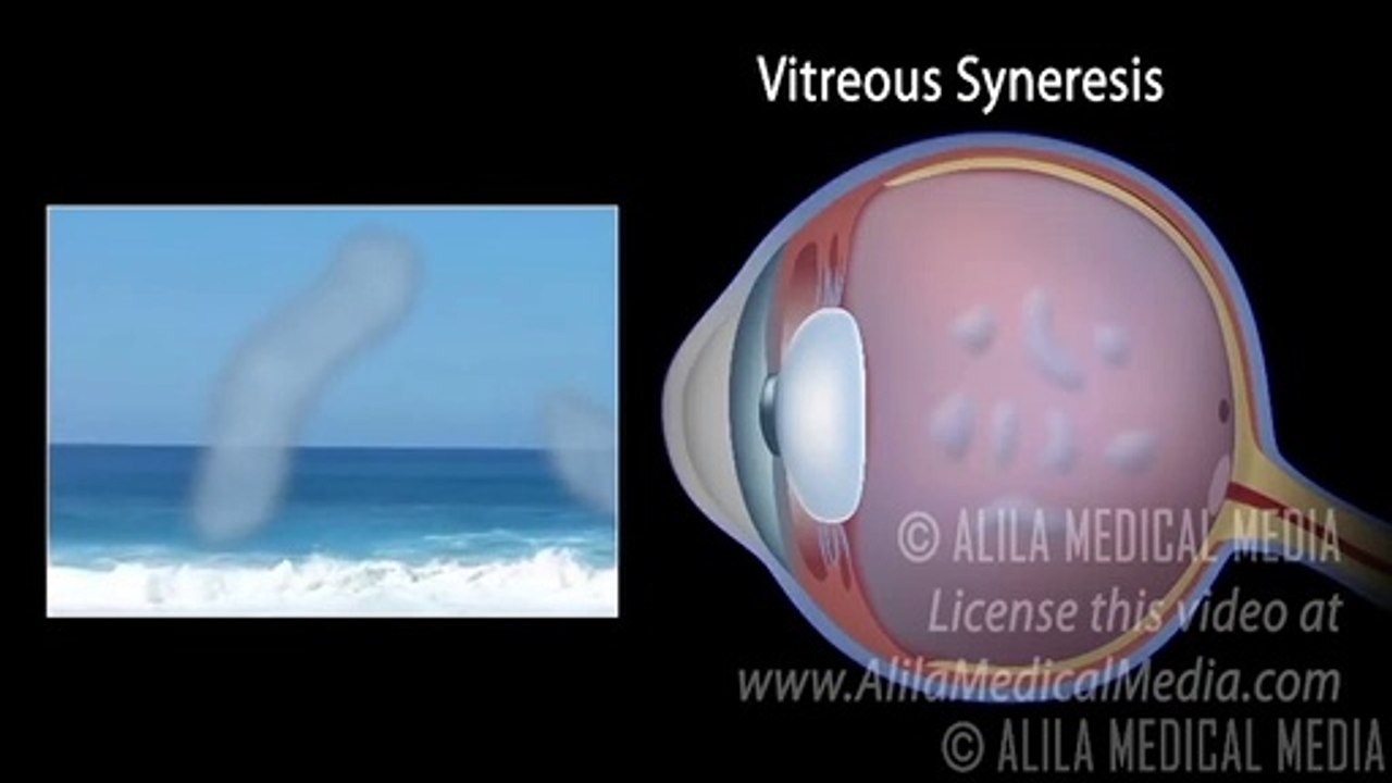 Eye Floaters and Flashes, Animation.