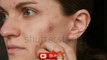 How to remove pimples- ব্রণ-দূর-করার-উপায়-Brono dur korar upay-Brono dur korar barof-Bron dur kor te barofer babohar-Bron dur korar paddhati