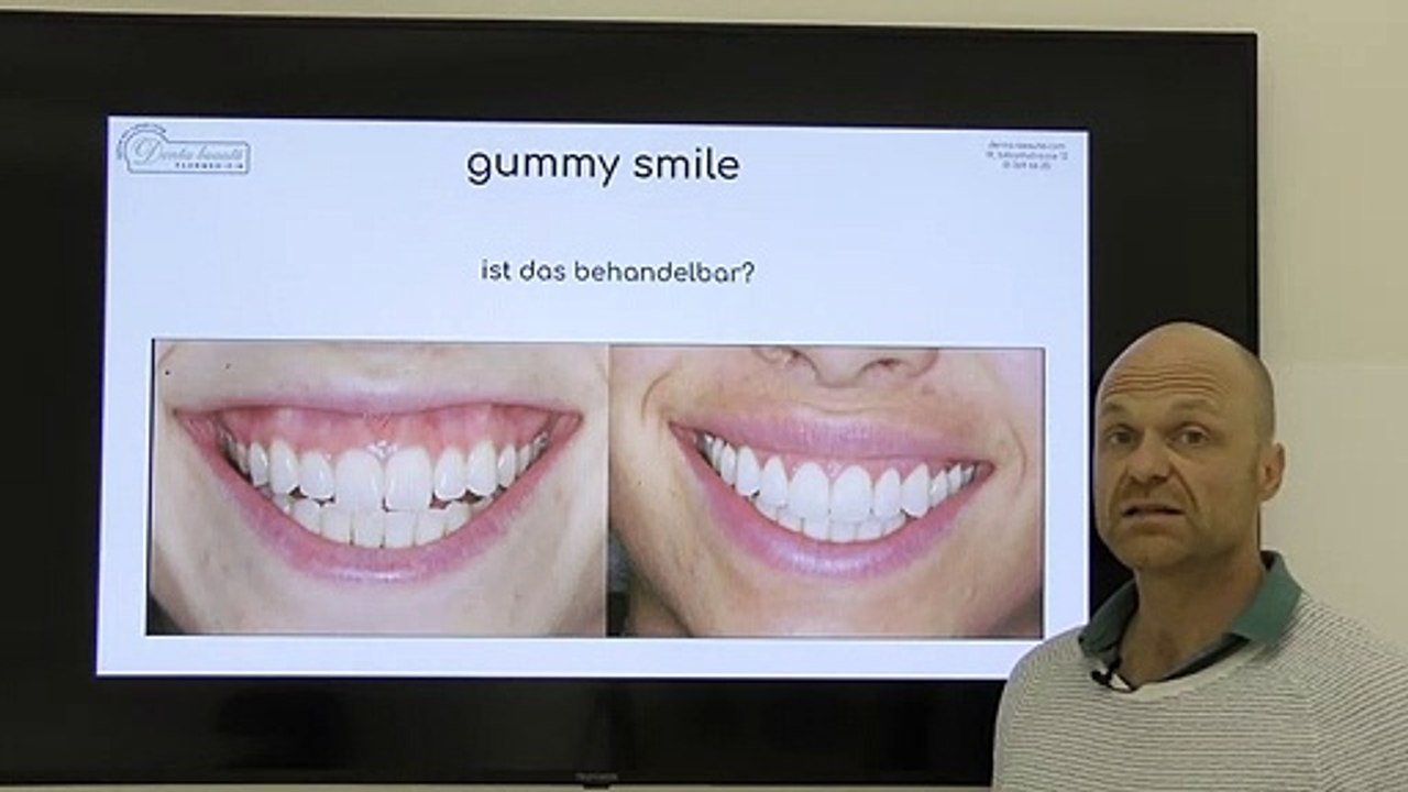 Gummy Smile - kann man das behandeln?