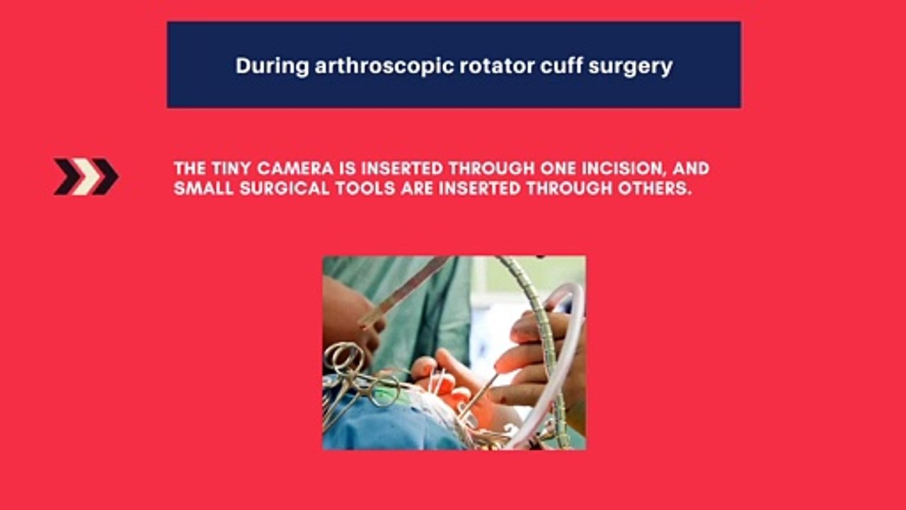 What does an arthroscopic rotator cuff surgery involve|Rotator Cuff injury|Bone and joint consult