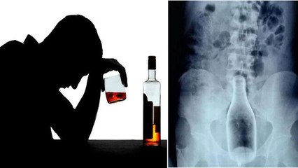 A Drunk Man Inserts Glass Bottle Into Body Through Anus