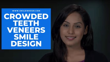 Crowded Teeth Veneers-Smile Makeover, Smile Design & Dental Makeovers | Smile in Hour® Dentist Review
