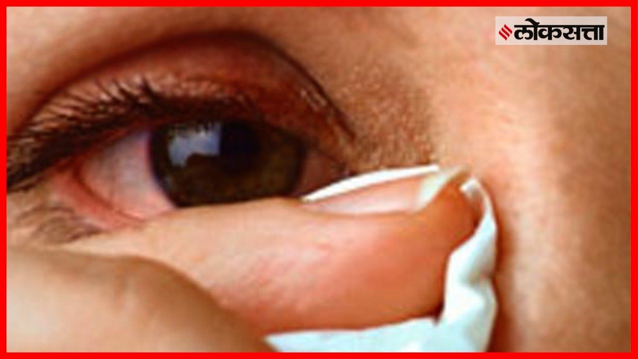 How to Remove Dust From EyeAll changes saved.