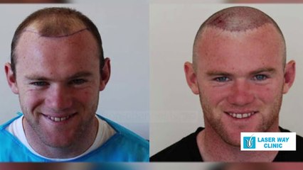 Hipokrati - Mbjellja e flokëve Personazhe te njohur që e kanë bërë - 30 Maj 2020