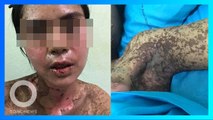 Kulit wanita pecah hingga mengelupas karena alergi ibuprofen - TomoNews