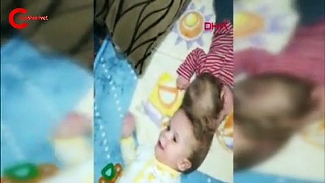 Antalyalı siyam ikizleri, İngiltere'de ayrıldı