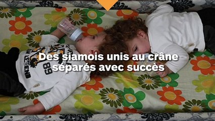 Des siamois unis au crâne ont été séparés avec succès