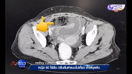 หญิงวัย 60ปี ไร้ฟัน กลืนส้มตำแบบไม่เคี้ยว ลำไส้อุดตัน