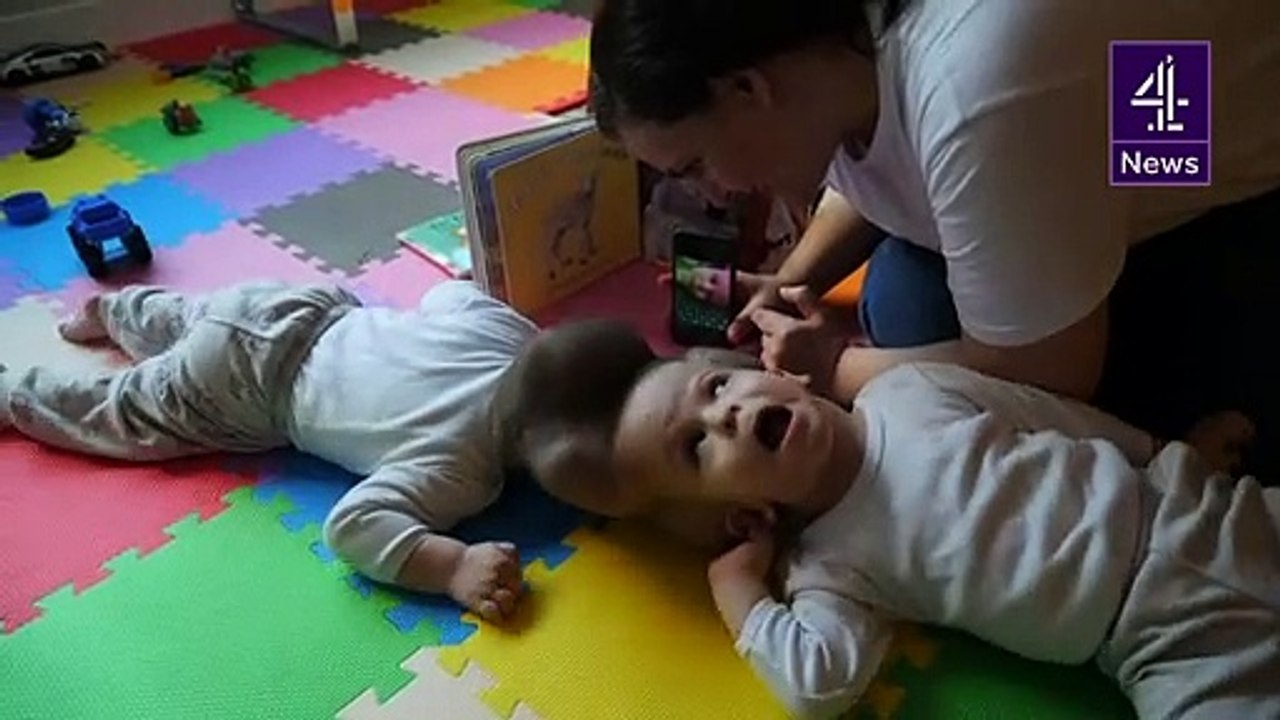 Parents joy as conjoined twins separated