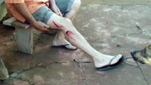 Homem tem corte na perna após sofrer acidente com máquina de serra