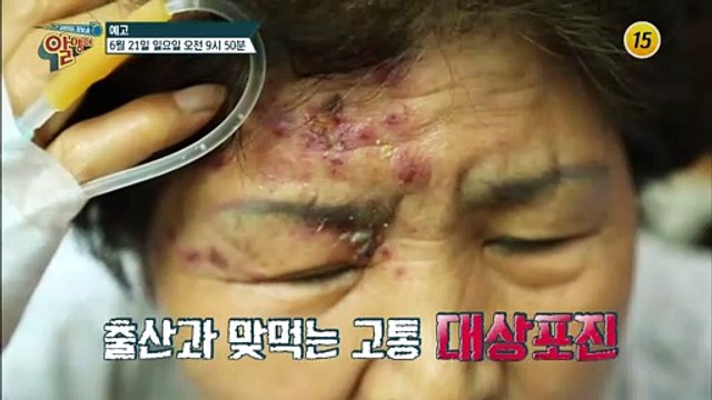 끔찍한 후유증 유발하는 대상포진 예방법 전격 공개!_알맹이 78회 예고
