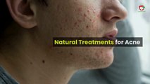 natural-treatments-for-acne