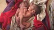 Miracle Baby born with 2 heads, 4 arms and 2 legs, in India