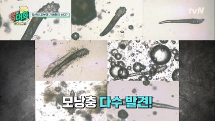 ※충격주의※ 얼굴 위에서 살아 움직이는 모낭충
