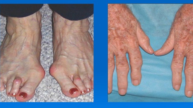 bd-como-tratar-dolor-de-articulaciones-010720