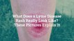 What Does a Lyme Disease Rash Really Look Like? These Pictures Explain It