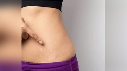 जिद्दी स्ट्रेच मार्क्स घरेलू नुस्खों से दूर करें । Home Remedies For Cure Stretch Marks । Boldsky