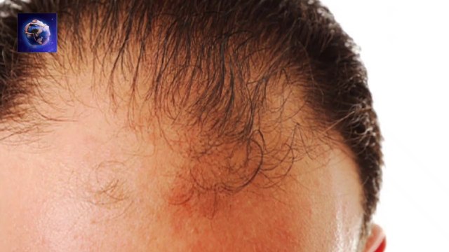 Best Hair Fall Solution __ Promote Regrowth of New Hair __ Dandruff __ Home Solution __ Hindi