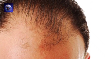 Best Hair Fall Solution __ Promote Regrowth of New  Hair __  Dandruff __ Home Solution __ Hindi
