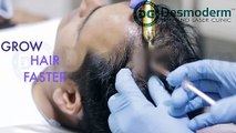 PRP Treatment in Delhi