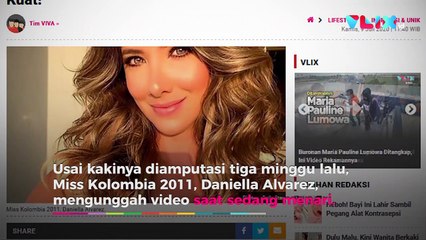Usai Diamputasi, Miss Kolombia Menari dengan Satu Kaki