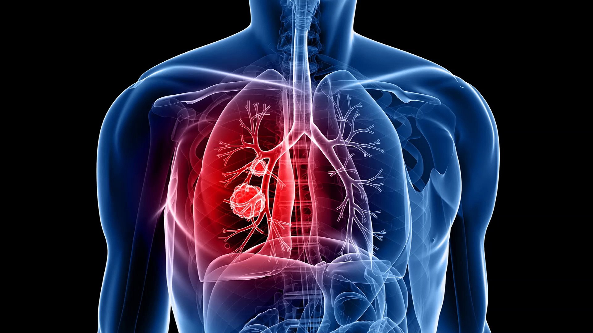 What Is Lung Cancer